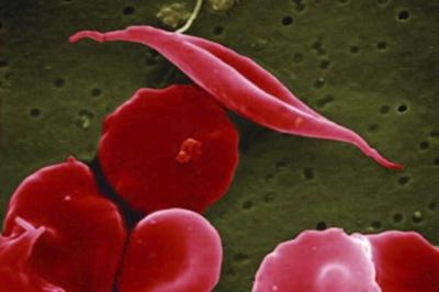 Sickle cell affects more families in Africa and India, but new gene therapies are out of reach
