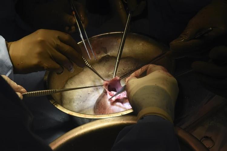 Surgeons perform second pig heart transplant, trying to save a dying man