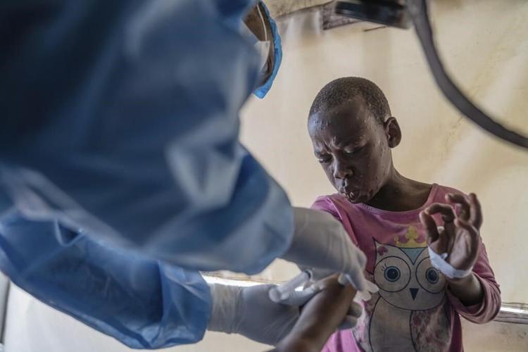 Africa's mpox outbreaks result from neglect and world's inability to stop epidemics, experts say