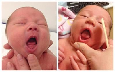 Infants' tongue-tie may be overdiagnosed and needlessly treated, American Academy of Pediatrics says