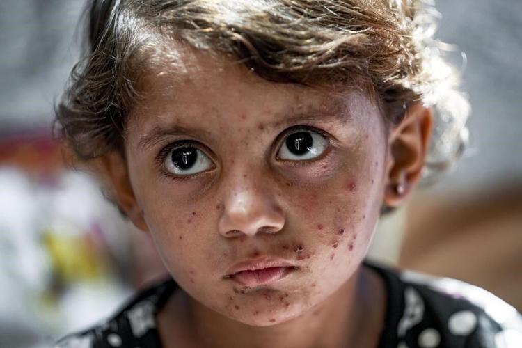 Lice, scabies, rashes plague Palestinian children as skin disease runs rampant in Gaza's tent camps
