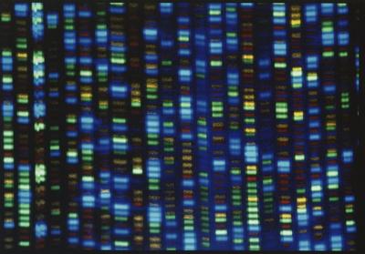 Takeaways from AP's report on access to gene therapies for rare diseases