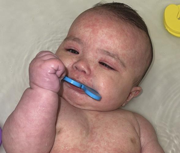'She could have died.' Alberta mother feared the worst for 4-month-old with measles
