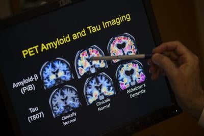 UK regulator approves second Alzheimer's drug in months but government won't pay for it