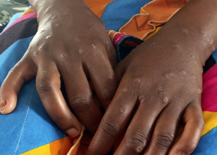 US aid cuts are hurting Africa's ability to respond to disease outbreaks, health chief says