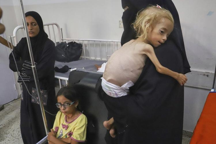 Doctors in Gaza say patients' protruding ribs and bony limbs offer evidence of malnutrition