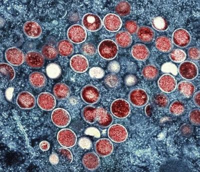 UN health agency convening experts to determine if the mpox outbreak in Africa is a global emergency