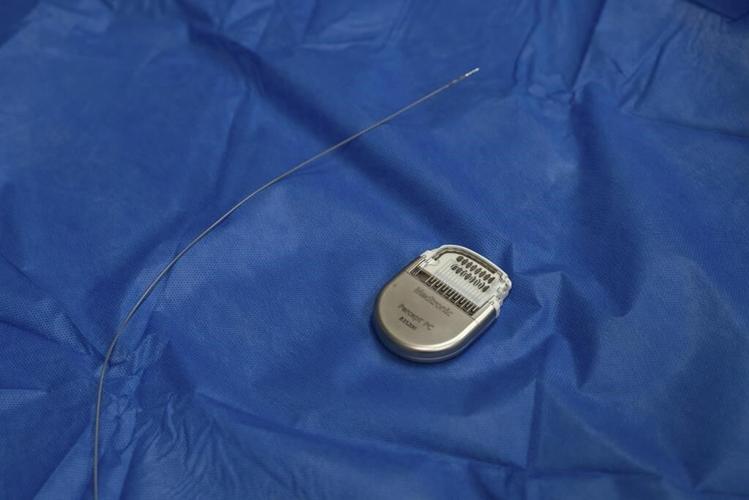 A pacemaker for the brain helped a woman with crippling depression. It may soon offer hope to others