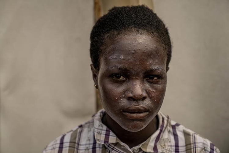 Congo reports more than 1,000 new mpox cases in a week. African authorities ask for vaccines