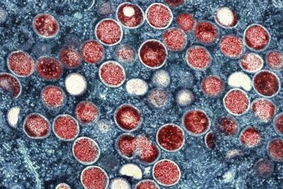 Vancouver's health authority says cases of mpox virus on the rise