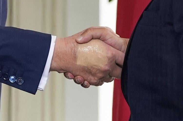 Trump is checked for lower leg swelling and diagnosed with a common condition in older adults