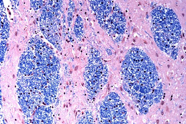 Surprise finding sheds light on what causes Huntington's disease, a devastating fatal brain disorder