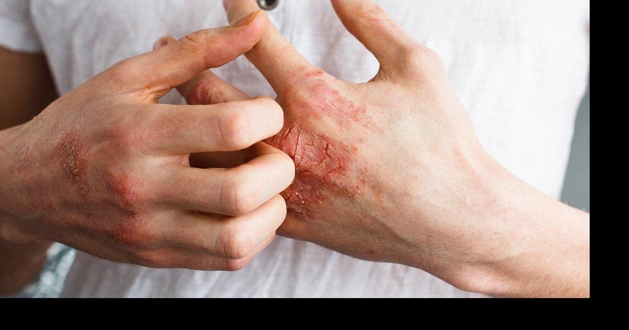 Dry, Cracked Hands That Won’t Go Away? 5 Things to Know About Chronic ...