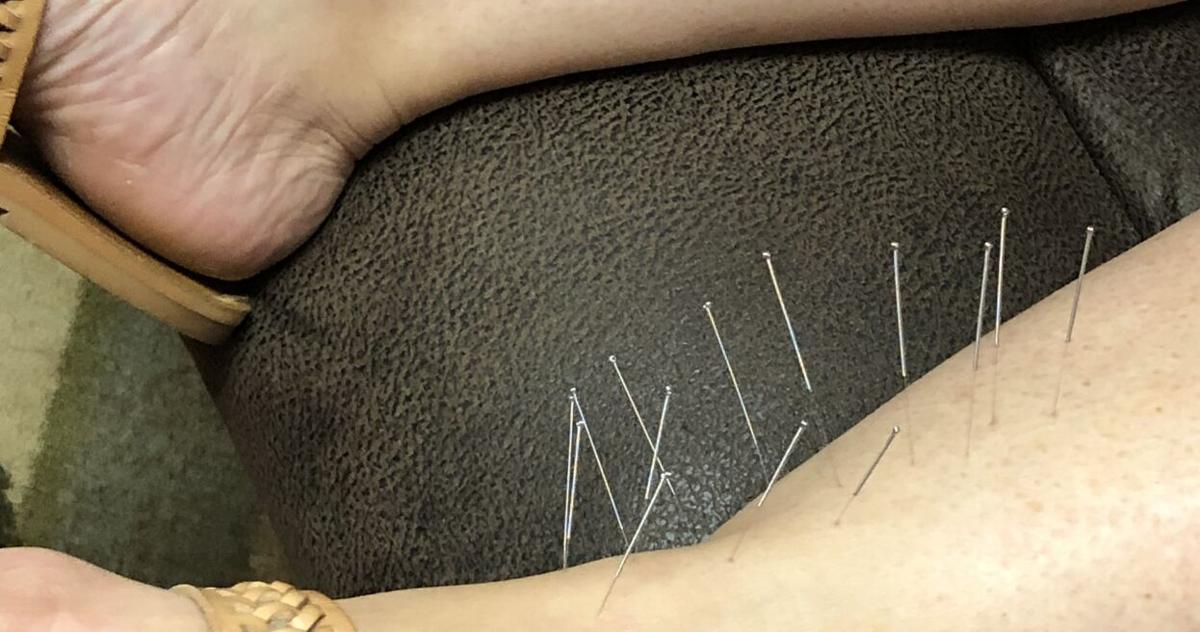 Cebulskie Acupuncture merges ancient medicine with modern technology |  Local