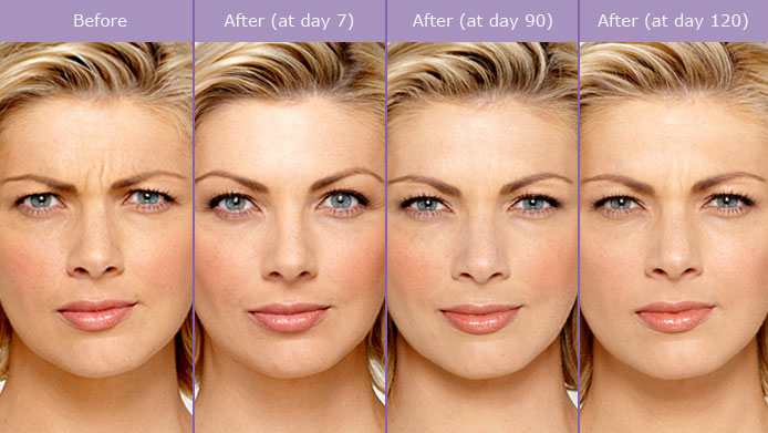 Botox1BeforeAfterPhoto.png