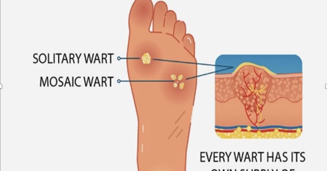 Plantar warts are spread by direct contact