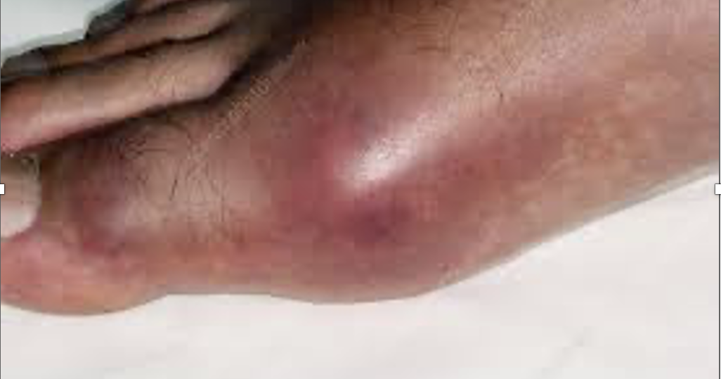 Natural treatment for gout