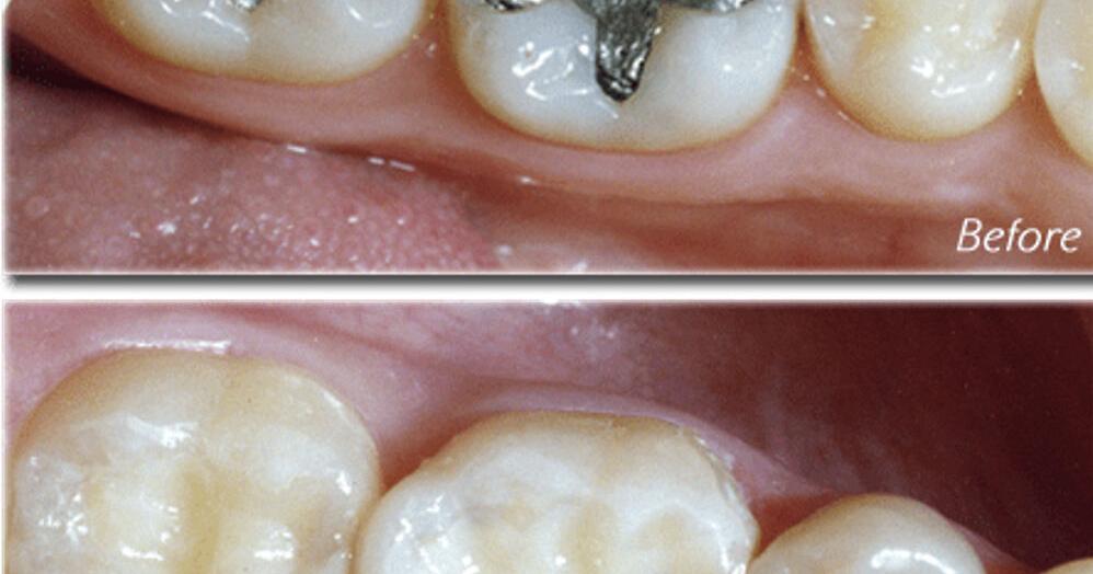Should 'silver' fillings be removed?