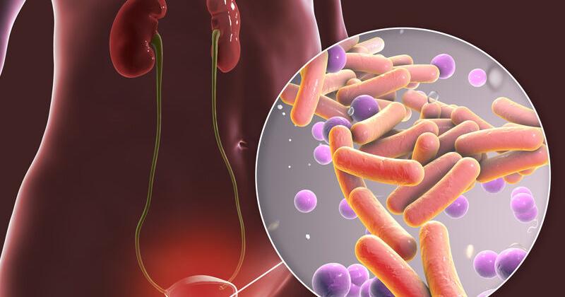Not every UTI is 'just a urinary tract infection'