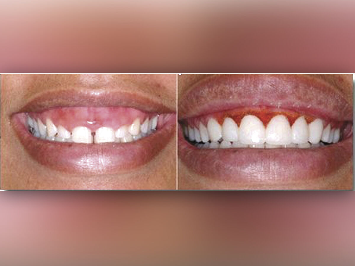 pauly d veneers before and after