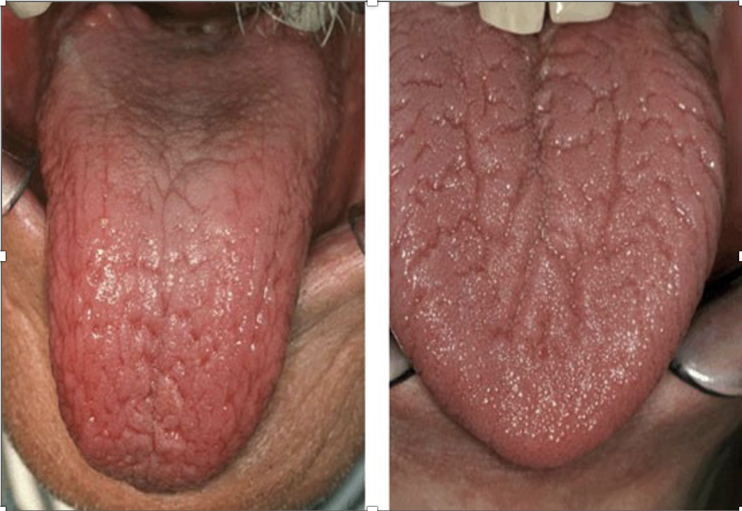 Dry mouth and 'Ozempic mouth': Rising concern for oral health | Lifestyles 