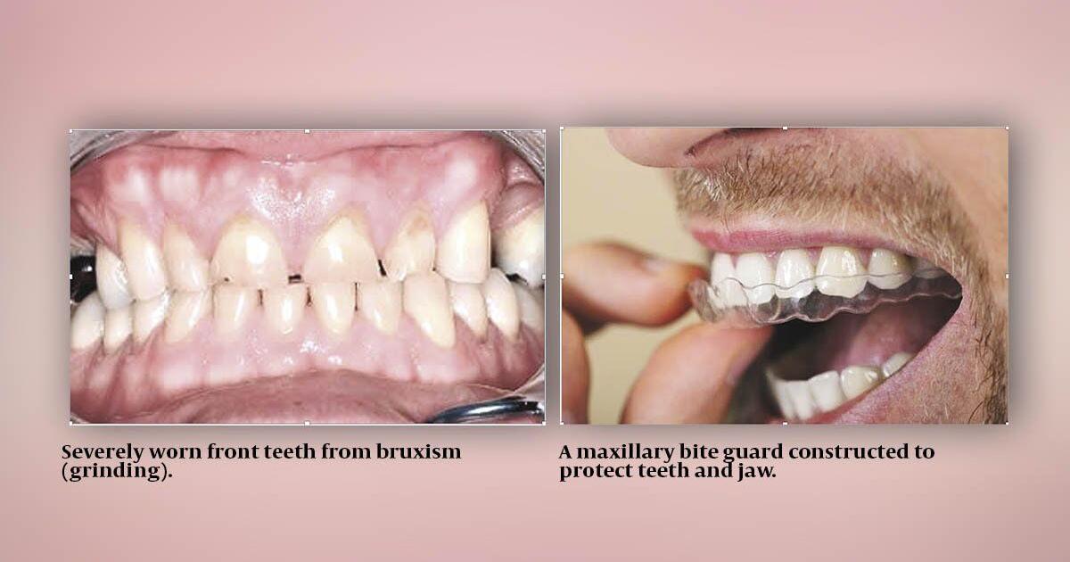 How to Know If You are Grinding Your Teeth: Quick Signs