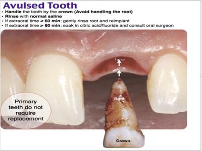 What to do if a tooth gets knocked out | The Specialist ...