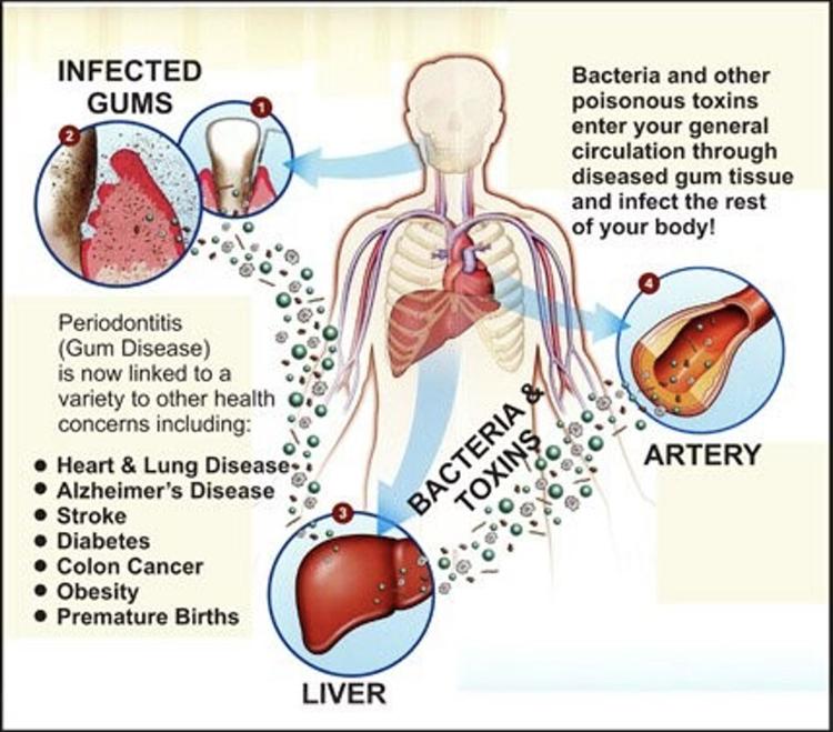 Healthy gums, healthier life: The dangerous link between gum disease ...