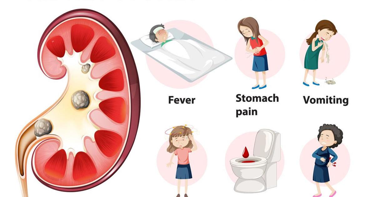 Kidney stones and the great Bahamian myth machine