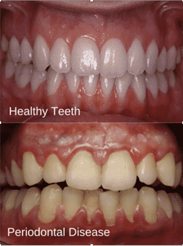 healthy bottom teeth pictures