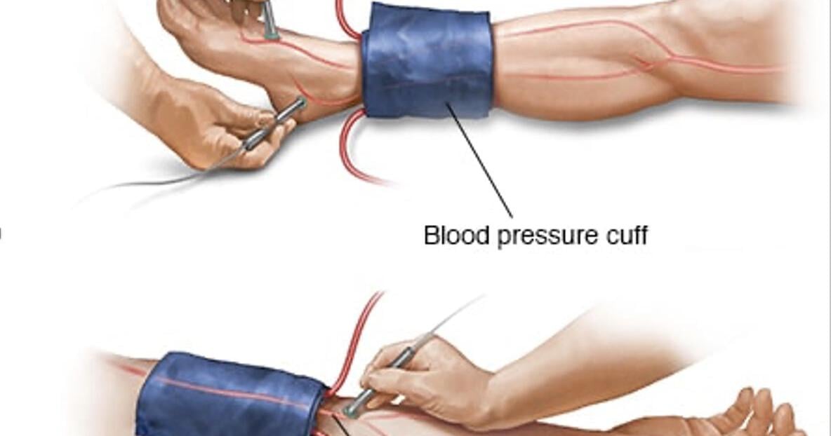 Ankle-brachial index: What it is and why you should have it done