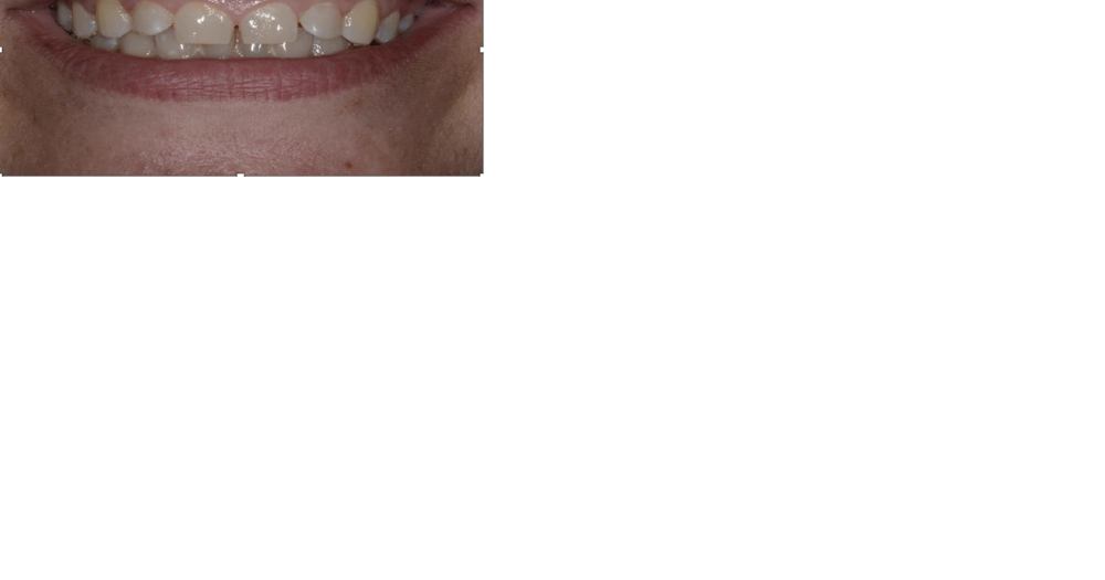 How veneers can enhance your smile - Vimarsana News
