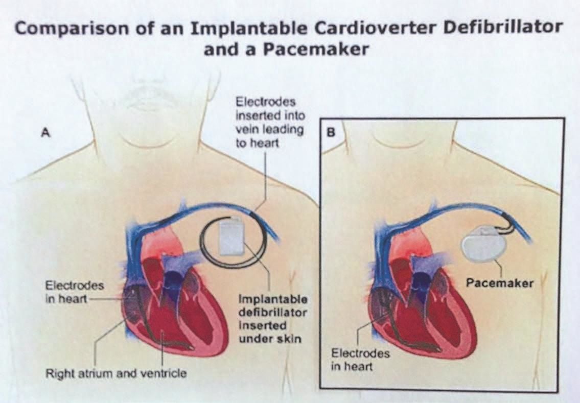 Pacemaker defibrillator shop