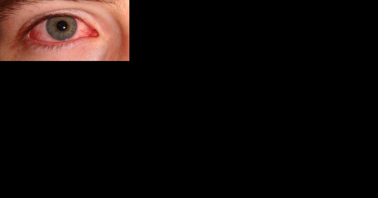 Pink eye is on the rise; nurses say it could indicate other infections, like COVID - Vimarsana News
