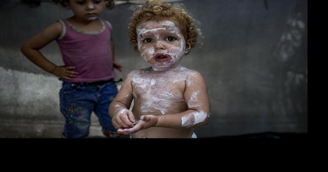 Lice, scabies, rashes plague Palestinian children as skin disease runs ...