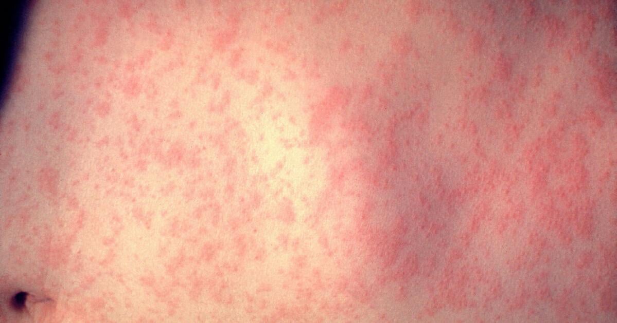 Public health investigating measles exposure at MacKids - Vimarsana News
