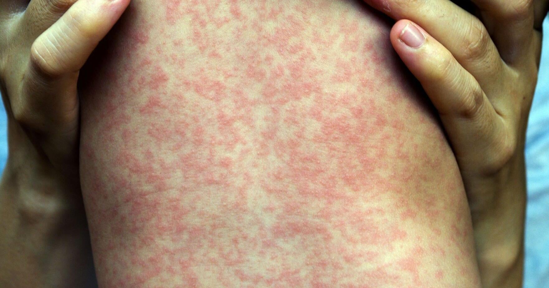 Measles exposure warning issued for 4 high - traffic GTA sites