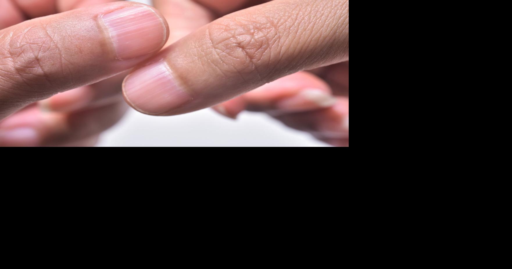 From thyroid issues to cancer, here’s what your fingernails can tell you about your health