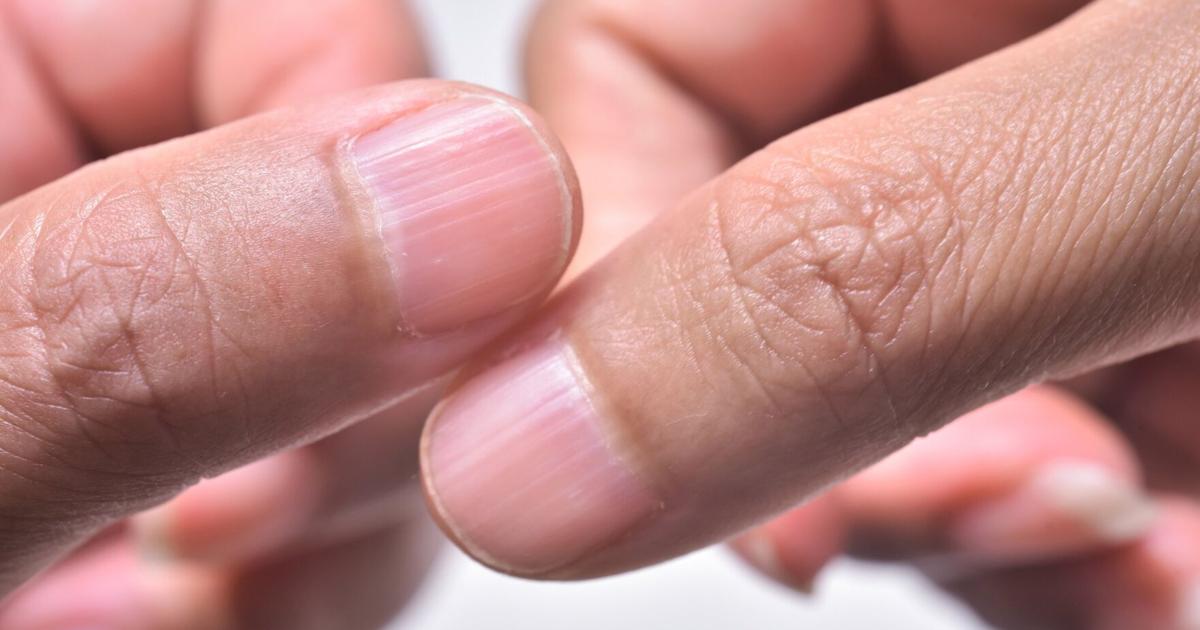 From thyroid issues to cancer, here’s what your fingernails can tell you about your health