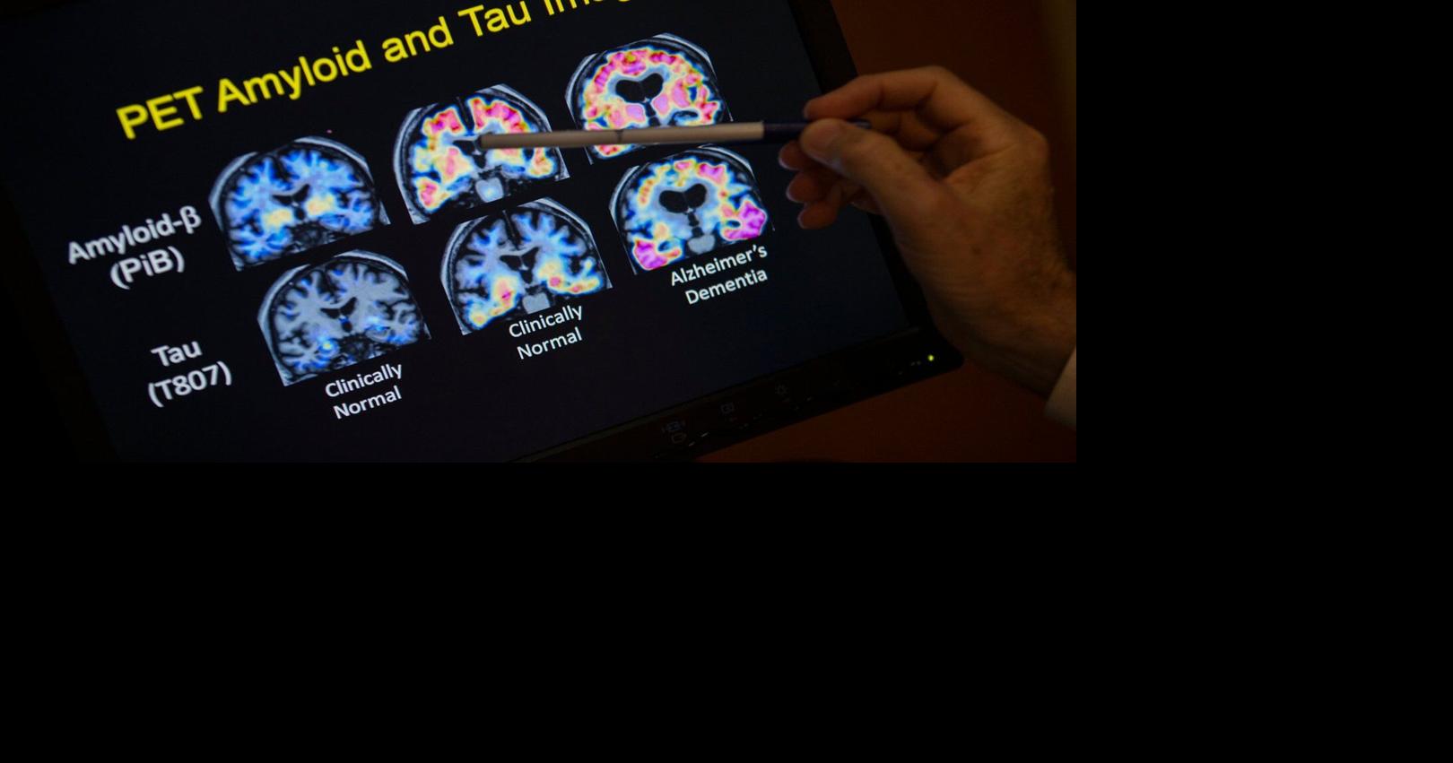 Want to lower your risk of dementia? It doesn't involve a blood test