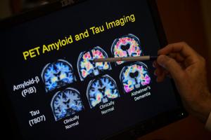 Want to lower your risk of dementia? It doesn't involve a blood test