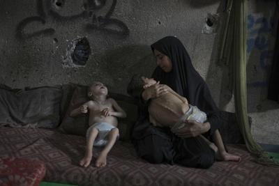 PHOTO ESSAY: Starvation attacks the bodies of these children in Gaza