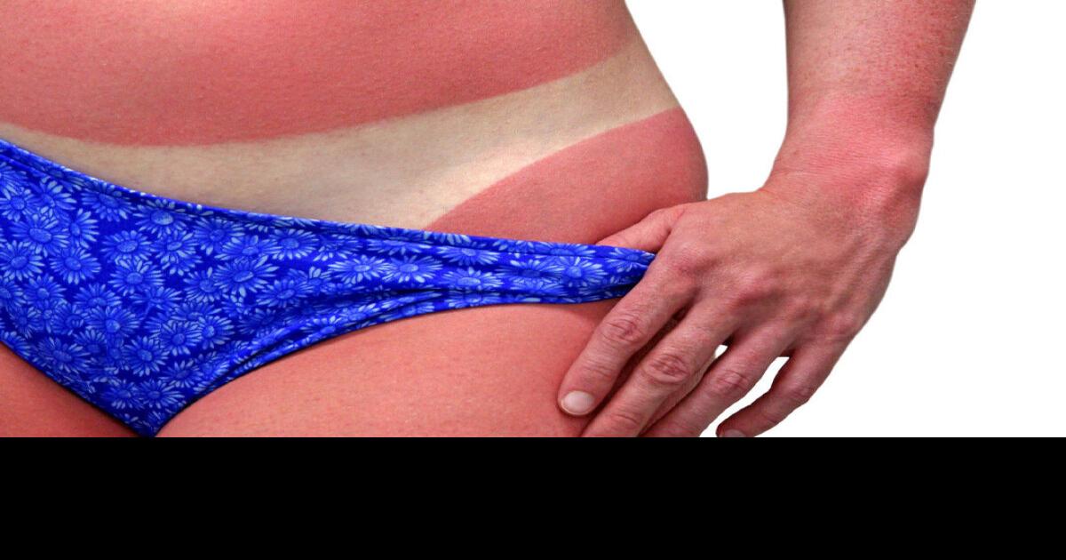 Scientists figure out why a sunburn hurts