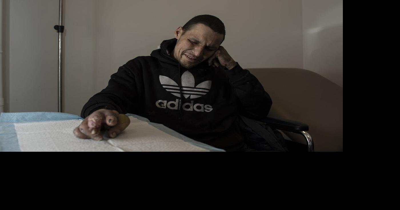 ‘Frostbite capital’: Efforts to reduce frostbite amputations underway in Edmonton