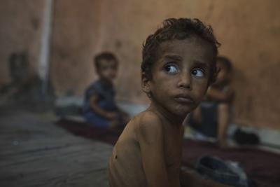 malnourished child in Gaza