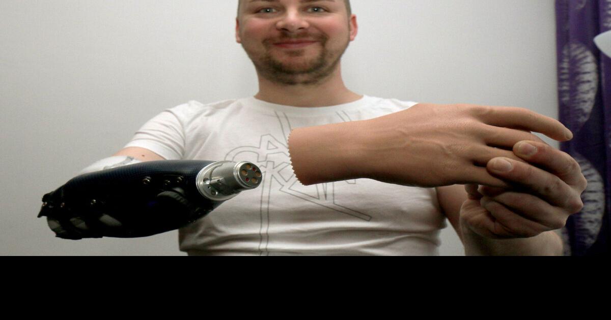 Three Austrian men first to get bionic hands after amputation