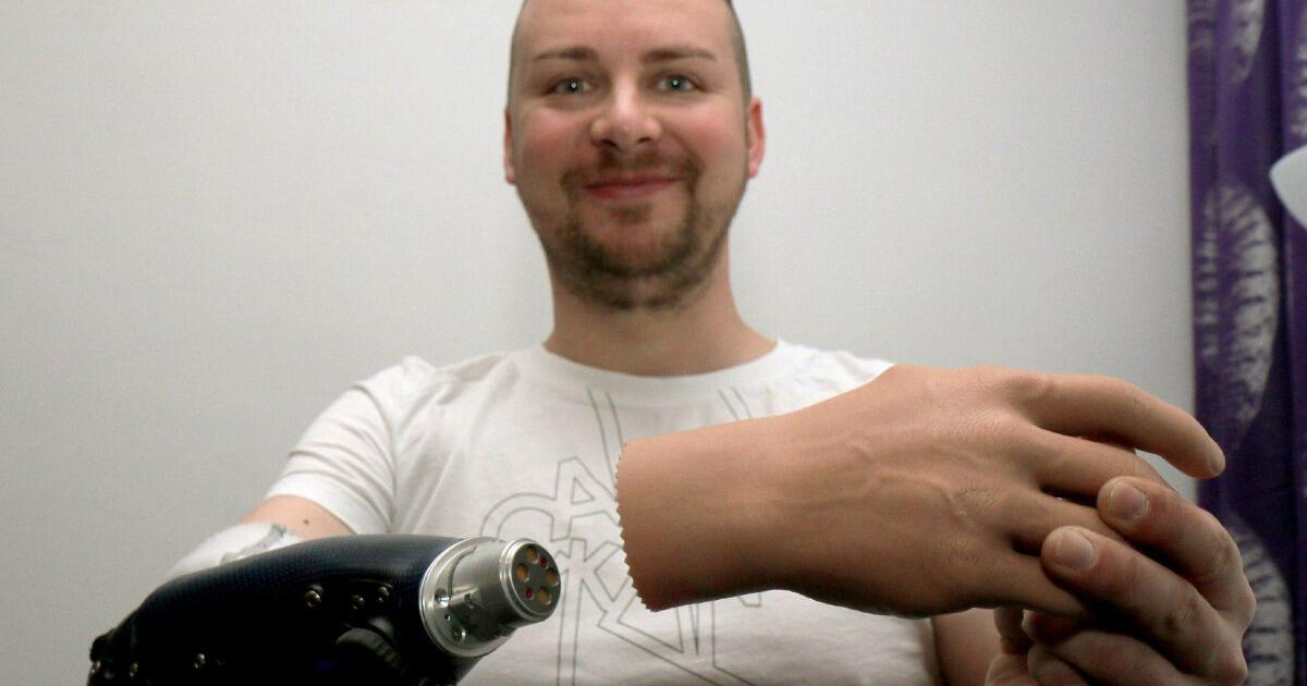 Three Austrian men first to get bionic hands after amputation