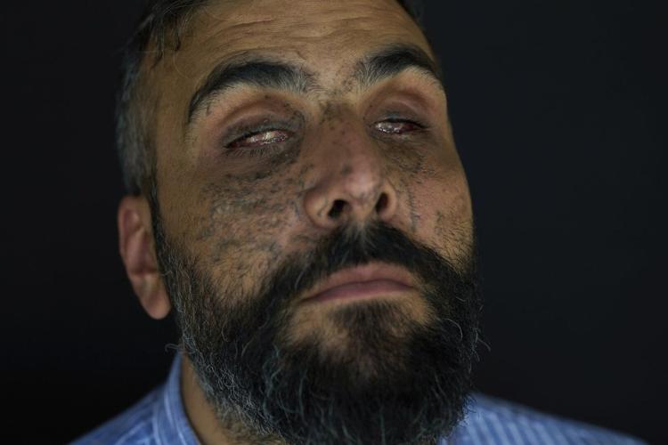 PHOTO ESSAY: Portraits of survivors of Israel's pager attack on ...