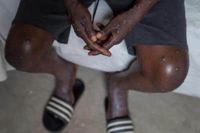 Mpox strain spreading in African countries could arrive in Canada, doctors say
