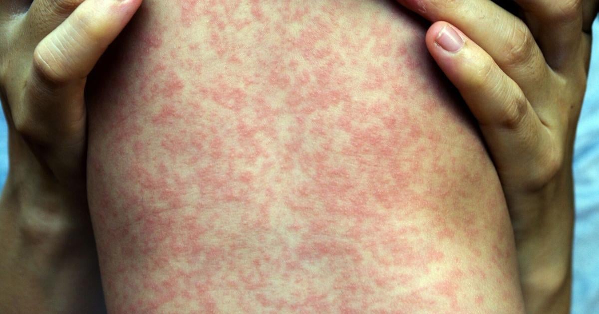 Ontario measles cases more than double over past two weeks; hospitalizations up to 31 - Toronto Star